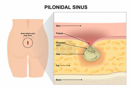 Ilustración del vector de la enfermedad del seno pilonidal