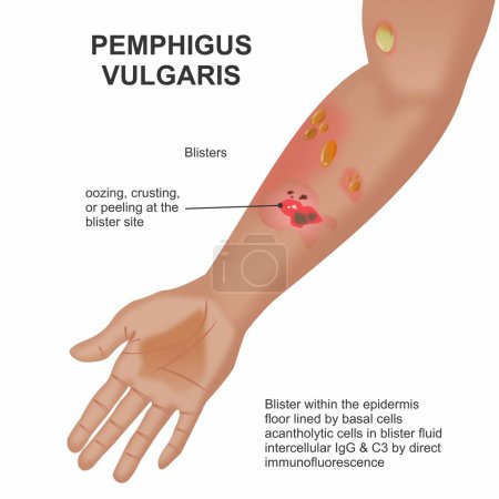 Pemphigus vulgaris Illustrationsblasen an der Hand