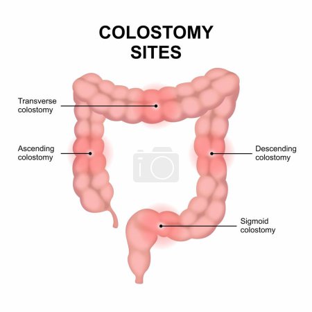 Colostomy Sites colon cancer illustration