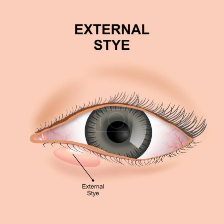 Stye externo (Sty) ilustración del ojo