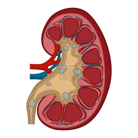 Illustration for Anatomy of Kidney Stones. Medical Concept of Urinary System Disease. Vector Illustration of Human Internal Organs - Royalty Free Image