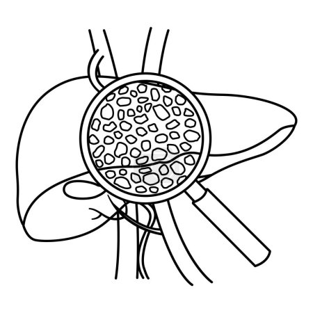 Illustration for Liver Disease for Coloring Page. Cirrhosis of the Liver under a Magnifying Glass. Vector Illustration of Human Organs. Anatomy and Medicine - Royalty Free Image
