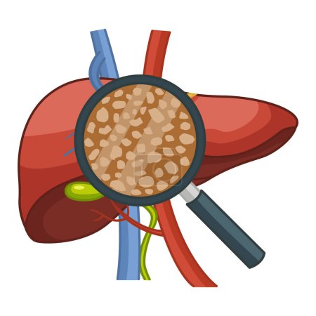 Illustration for Liver disease. Cirrhosis of the Liver under a Magnifying Glass. Vector Illustration of Human Organs. Anatomy and Medicine - Royalty Free Image