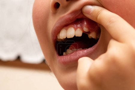 Téléchargez les photos : Bouche d'un enfant avec des dents manquantes - en image libre de droit