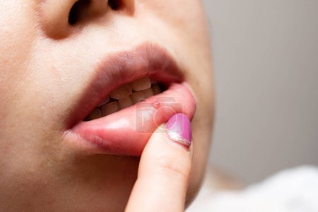 Téléchargez les photos : Lèvres d'une femme atteinte de stomatite - en image libre de droit