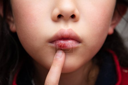 Téléchargez les photos : Un enfant aux lèvres sèches et rugueuses - en image libre de droit
