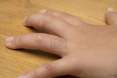 Hand-Maul- und Klauenseuche auf Holztisch