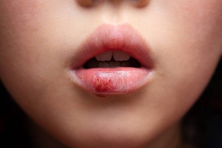 Un enfant aux lèvres sèches et rugueuses