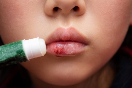 Téléchargez les photos : Un enfant qui applique du baume à lèvres sur les lèvres rugueuses - en image libre de droit