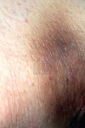 Photo for A Close Up of a Big Bruise on a Body Part Knee From Tripping UP and Falling Down - Royalty Free Image