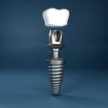 Photo for Photo dental implants surgery 3d rendering - Royalty Free Image