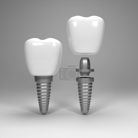 Photo dental implants surgery 3d rendering