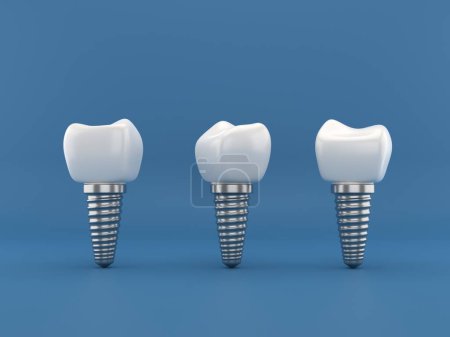 Téléchargez les photos : Implants dentaires chirurgie rendu 3d - en image libre de droit