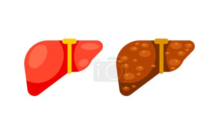 Healthy liver and liver cirrhosis disease. Human liver organ. Vector illustration.