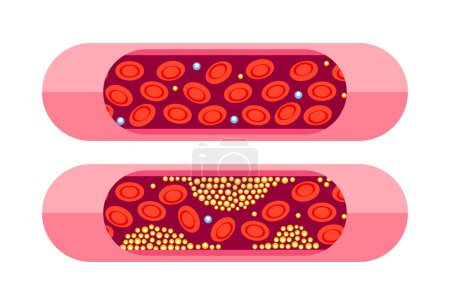 Types of cholesterol. HDL and LDL cholesterol types. Labeled educational normal and narrowed artery. Vector illustration.