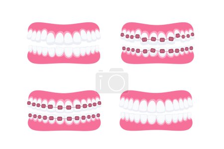 Teeth with braces. Orthodontic treatment. Tooth braces. Teeth with metal brackets.
