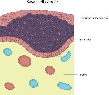 Illustration for Basal cell cancer. Skin disease. Tumor cells. Skin cancer. - Royalty Free Image