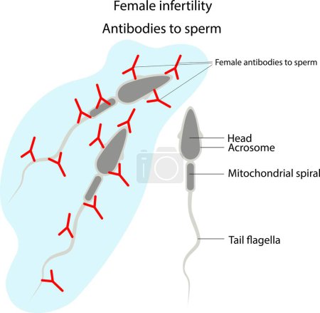 Illustration for Female infertility. Antibodies to sperm. The structure of the sperm. - Royalty Free Image