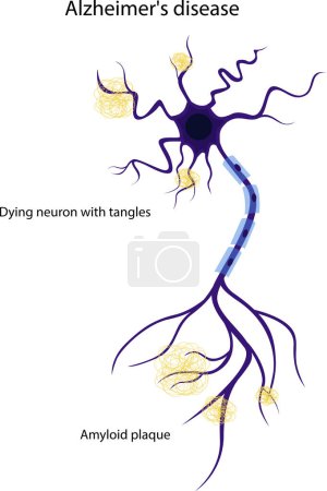 Illustration for Vector illustration of a damaged neuron. The structure of a diseased neuron. Alzheimers disease. Brain disease dementia, memory disorders. - Royalty Free Image