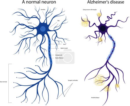 Sick and healthy neuron. Damaged neuron. Alzheimers disease. Brain disease dementia, memory disorders. A neuron in Alzheimers disease