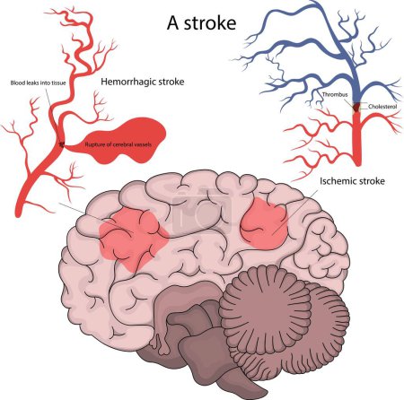 Ilustración de Accidente cerebrovascular hemorrágico e isquémico del cerebro. - Imagen libre de derechos