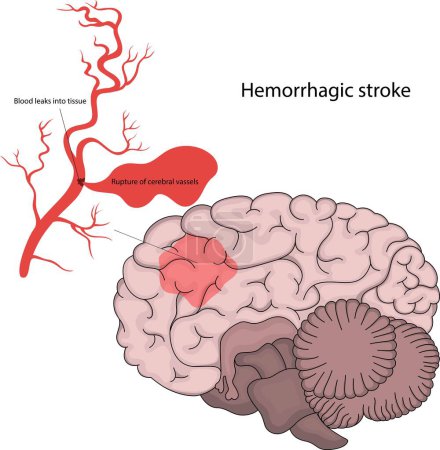 Téléchargez les illustrations : Illustration vectorielle d'un AVC hémorragique. Rupture des vaisseaux sanguins et hémorragie dans les tissus environnants du cerveau. Maladie cérébrale. - en licence libre de droit