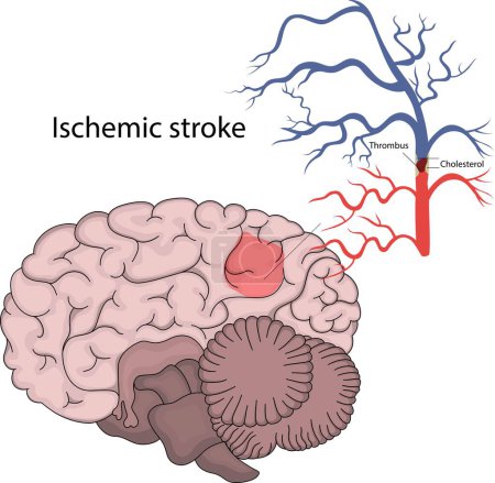 Vector illustration of ischemic stroke. Brain infarction. Blockage of a blood vessel in the brain.