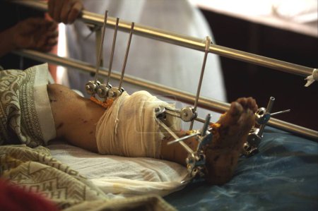 Foto de Injured foot of a victim of terrorist attack by Deccan Mujahedeen on 26th November 2008 treated in J.J. hospital in Bombay Mumbai ; Maharashtra ; India - Imagen libre de derechos