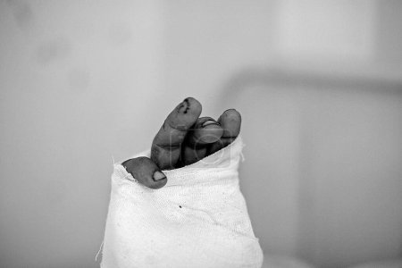 Foto de Abdul Rashid un ciudadano herido recuperándose en el hospital JJ durante las recientes explosiones de bombas el 26 de noviembre de 2008 en Bombay Mumbai, Maharashtra, India - Imagen libre de derechos