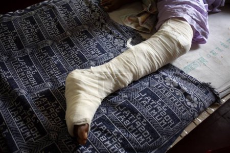 Foto de Pie herido; Víctima del ataque terrorista perpetrado por Deccan Mujahedeen el 26 de noviembre de 2008, atendida en el hospital J.J. de Bombay Mumbai; Maharashtra; India - Imagen libre de derechos