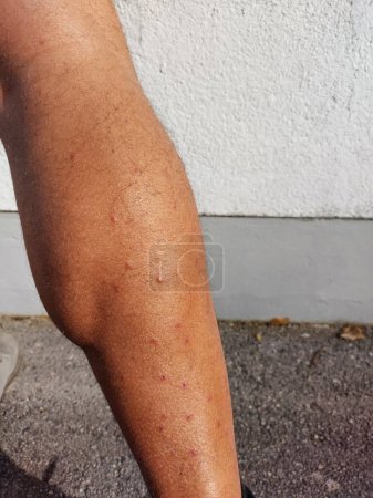 Caucasian mens lower leg covered with two week old bites by Forcipomyia taiwana, a small black mosquito, known as little King Kong. The insect leaves people with almost unendurable itching. Common in Taiwan and southern China