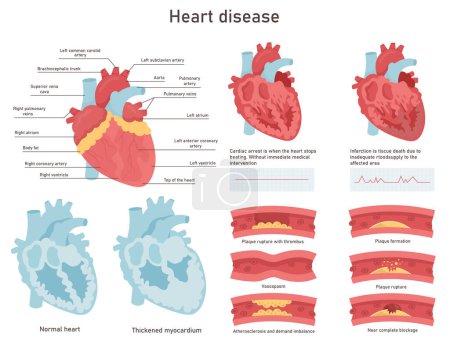 Heart disease illustration. Problems with heart. Heart attack and failure, myocarditis. Cardiology infographic