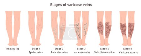 Etapas de venas varicosas. Venas varicosas en mujeres. Imagen de piernas sanas y enfermas. Infografía varicosa