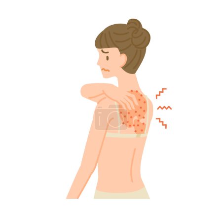 Illustration for A woman whose back skin is rough, inflamed, and itchy due to an allergic reaction. - Royalty Free Image