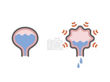 Overactive bladder and normal bladder icon