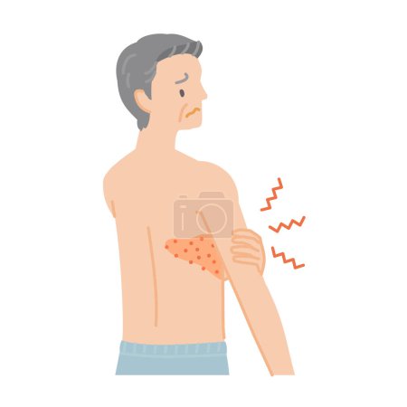 Gürtelrose: Älterer Mann mit Schmerzen, Juckreiz und Schwellungen vom Rücken bis zur Brust (Rückenansicht))