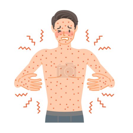 Rash: A man suffers from itching and pain all over his body due to hives.
