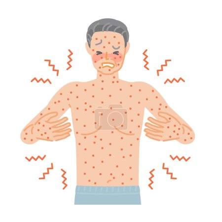 Rash: Senior man suffering from itching and pain all over his body due to hives Rash: Senior man suffering from itching and pain all over his body due to hives
