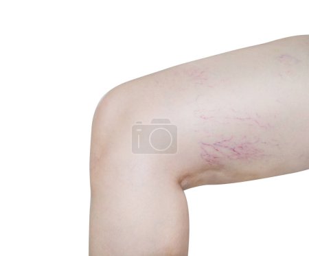 Woman reveals legs with varicose veins on her legs. Varicose vei