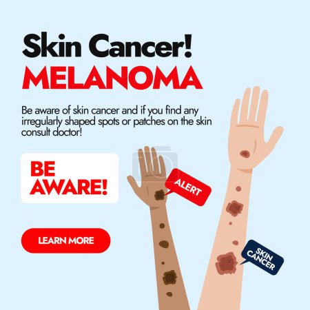 Melanoma Cáncer de piel. Poste de la conciencia del cáncer de piel con dos manos étnicas diferentes que tienen manchas del cáncer del melanoma. Publicidad en redes sociales para pacientes de cáncer de piel. Señales de alerta de melanoma.