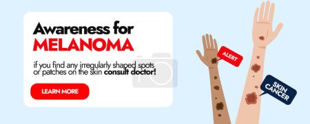 Melanoma Skin disease. Skin cancer awareness cover with two different ethnic hands having Melanoma cancer spots. Awareness social media banner for Skin infection Patients. Melanoma warning signs.
