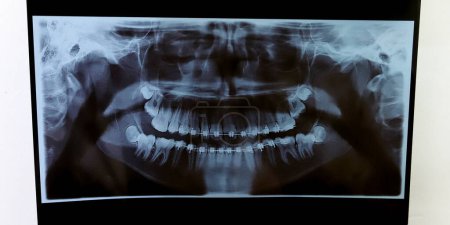 Téléchargez les photos : Rayon X d'une prothèse dentaire avec crochets. Radiographie de la bouche d'un adolescent avec orthodontie. Radiographie d'un patient avec un appareil orthodontique fixe. Santé dentaire. - en image libre de droit