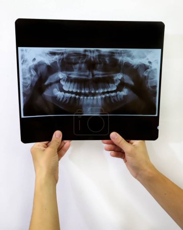 Téléchargez les photos : Radiographie d'une prothèse avec crochets. Radiographie de la bouche d'un adolescent avec orthodontie. Un dentiste qui regarde les radios. Dentiste tenant la radiographie d'un patient avec un appareil orthodontique fixe. Santé. - en image libre de droit