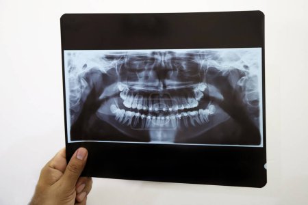 Radiografía de una prótesis con paréntesis. Radiografía de la boca de un adolescente con ortodoncia. Dentista mirando rayos X. odontólogo mano sosteniendo rayos X de un paciente con ortodoncia fija. Salud dental