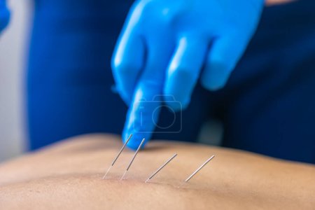 Photo for Close up of a needle and hands of physiotherapist doing a dry needling in a physiotherapy center. - Royalty Free Image
