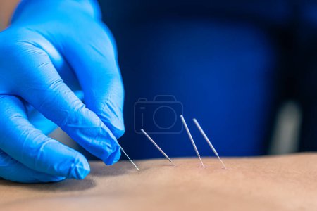 Nahaufnahme einer Nadel und der Hände eines Physiotherapeuten beim trockenen Nadeln in einem Physiotherapiezentrum.