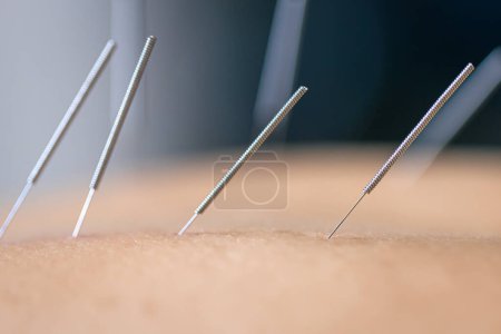 Dry needling acupuncture needles used by acupuncturist physiotherapist on patient in pain and injury treatment, close up macro photo.