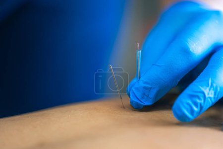 Photo for Close up of a needle and hands of physiotherapist doing a dry needling in a physiotherapy center. - Royalty Free Image