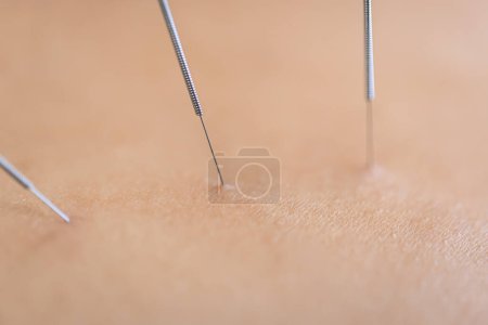 Photo for Dry needling acupuncture needles used by acupuncturist physiotherapist on patient in pain and injury treatment, close up macro photo. - Royalty Free Image