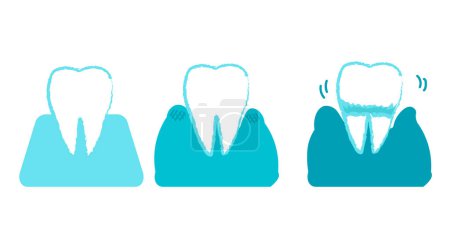 Progresión de la enfermedad periodontal Ilustración simple de los dientes